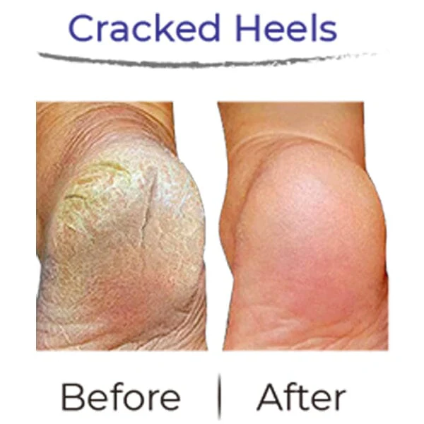 RevivaFoot Exfoliating Foot Peel Masks (2pk) | As Seen On Social! - Image 9